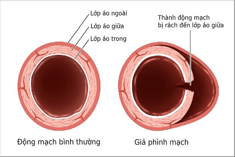 Tình trạng giả phình mạch có thể xảy ra ở bất kỳ động mạch nào bị tổn thương