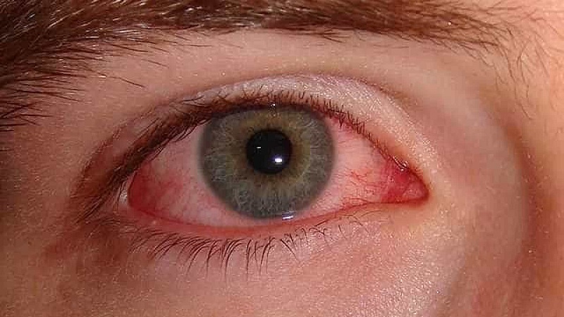Viêm mắt cũng có thể làm cho mắt bị mờ