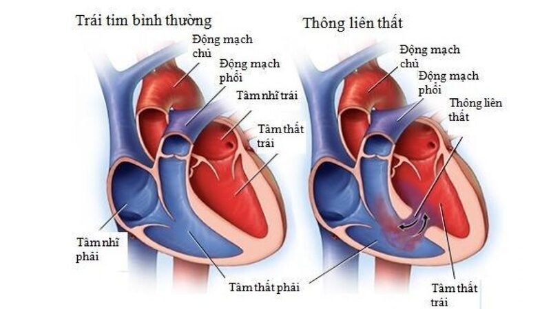 Kích thước tim bất thường có thể do bệnh lý van tim