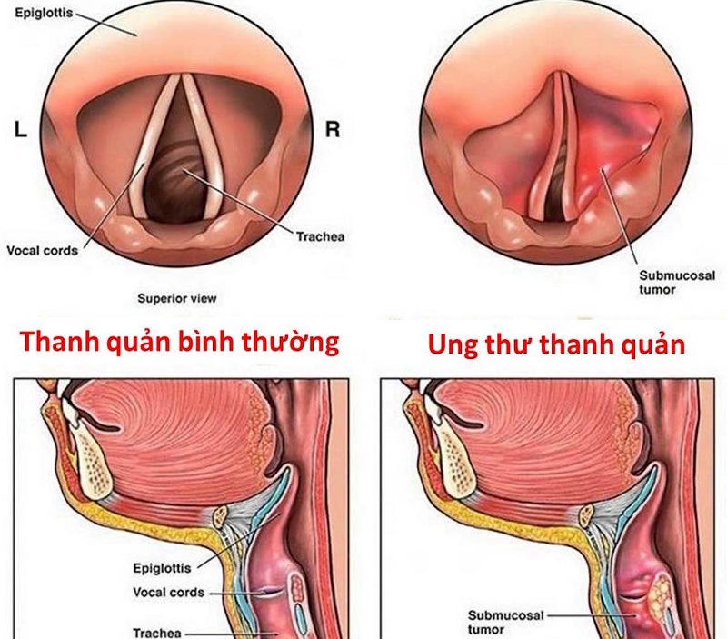 Ung thư thanh quản xảy ra ở biểu mô của thanh quản