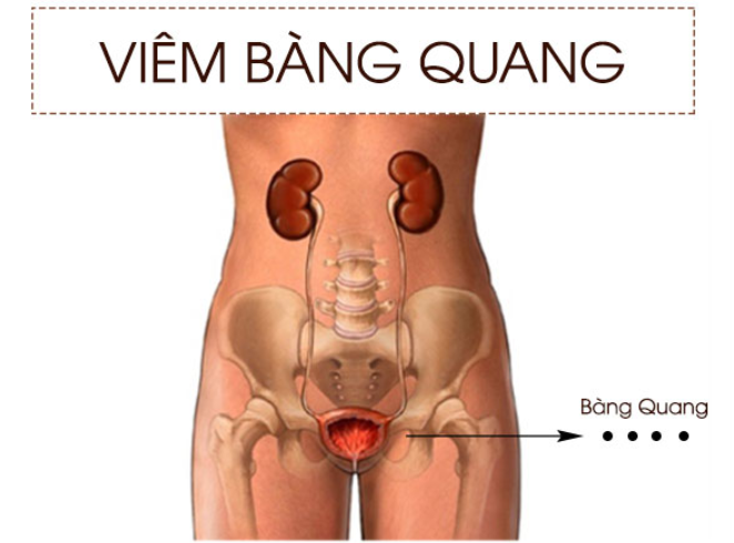 Viêm bàng quang cấp