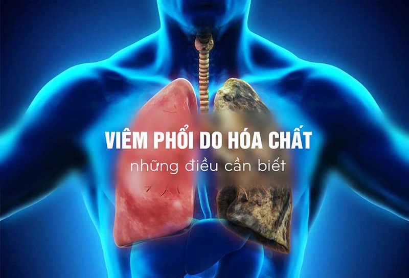 Viêm phổi viêm phổi do hít hóa chất chiếm tỷ lệ khá nhỏ trong những trường hợp người bệnh bị viêm phổi