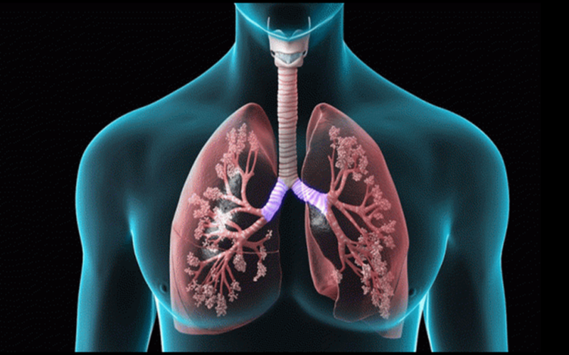 Các biến chứng của xơ phổi và 4 phương pháp điều trị bệnh phổ biến | Medlatec