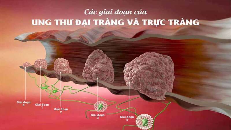 Ung thư đại trực tràng chia thành 5 giai đoạn tiến triển