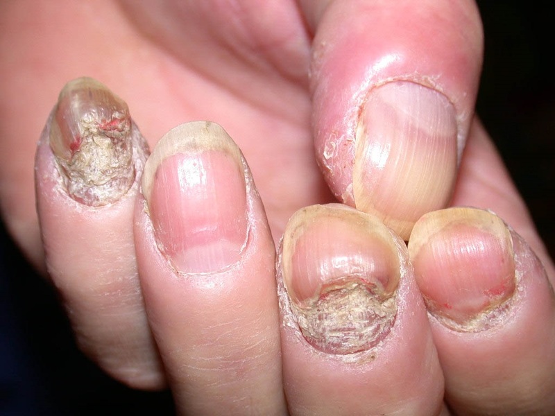 Nấm móng khiến cho móng tay người bệnh biến dạng, nhiễm trùng