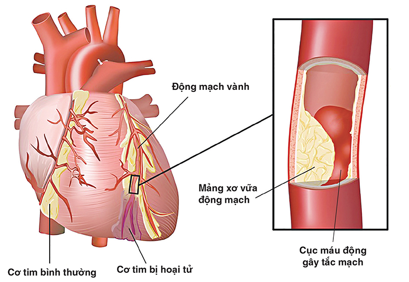 Đau ngực có phải bị bệnh động mạch vành không