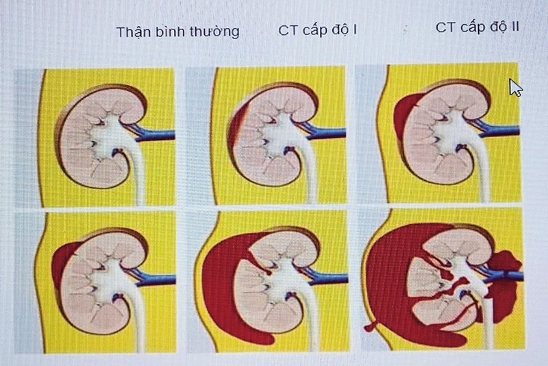 Chấn thương thận kín được chia ra thành nhiều cấp độ