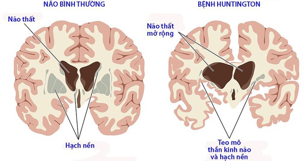 Bệnh Huntington: Triệu chứng, Nguyên nhân và Cách Điều Trị Hiệu Quả