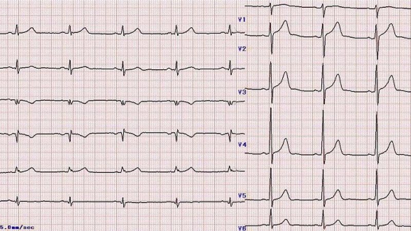 Điện tâm đồ có vai trò quan trọng trong chẩn đoán hội chứng QT