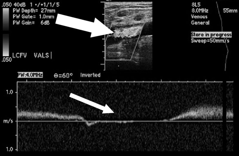 Tiến hành siêu âm Doppler để chẩn đoán bệnh