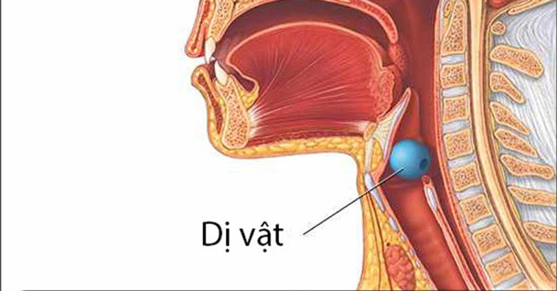 Biến chứng của dị vật đường thở