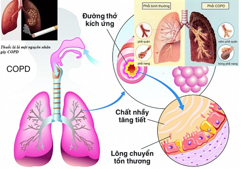 Người bị tắc nghẽn phổi mãn tính cũng có thể xuất hiện triệu chứng khó thở, tim đập mạnh