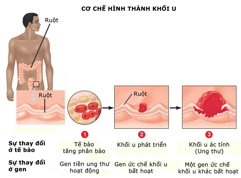 Mọi người đều có tế bào ung thư trong cơ thể nhưng không phải tế bào nào cũng tiến triển thành bệnh ung thư