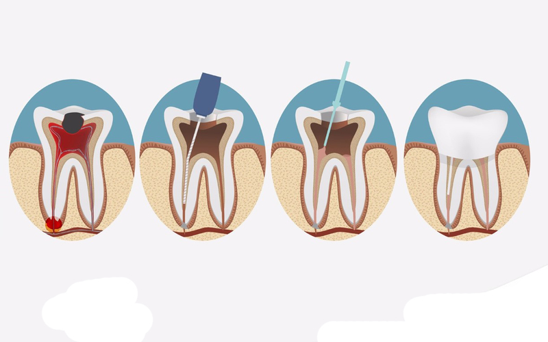 Tại sao cần phải điều trị tủy răng