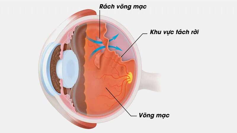 xuất huyết võng mạc