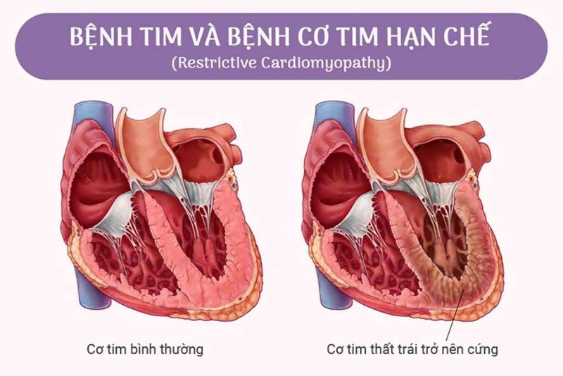 nguy cơ mắc bệnh cơ tim hạn chế