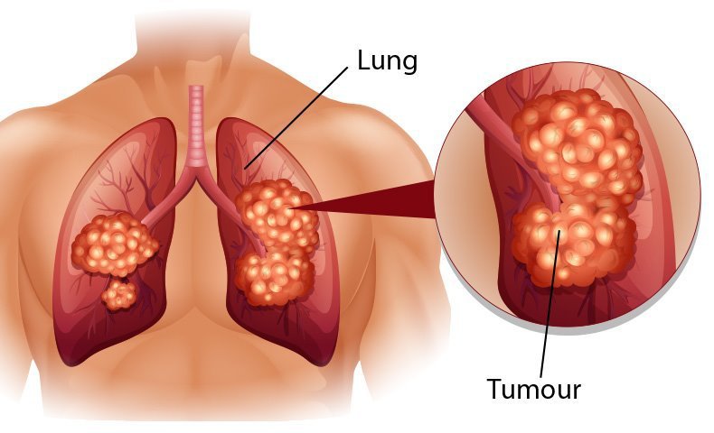 Những tiến bộ mới trong điều trị ung thư phổi