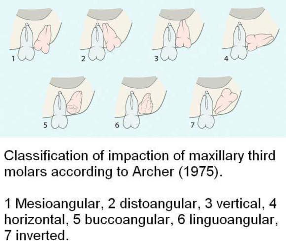 Hình thái răng khôn mọc hàm trên (theo Archer, 1975): 1. Lệch gần; 2. Lệch xa; 3. Mọc thẳng; 4. Nằm ngang; 5. Lệch má; 6. Lệch lưỡi; 7. Mọc ngược