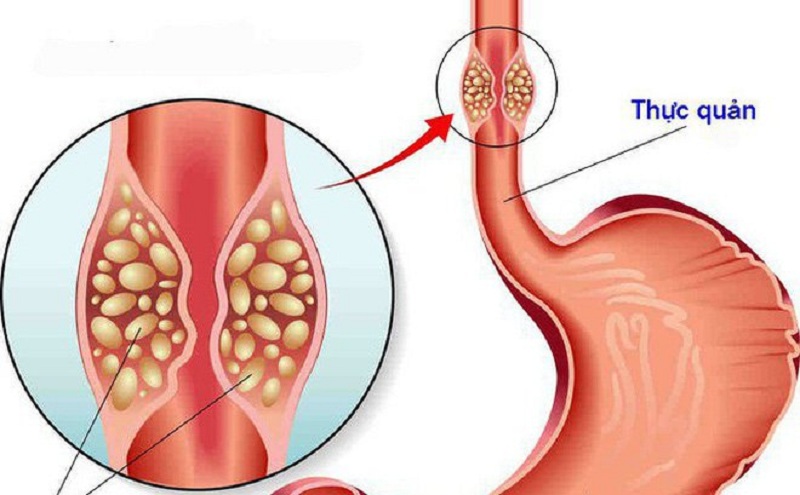 U Ác Thực Quản Là Gì? Tìm Hiểu Nguyên Nhân, Triệu Chứng và Điều Trị