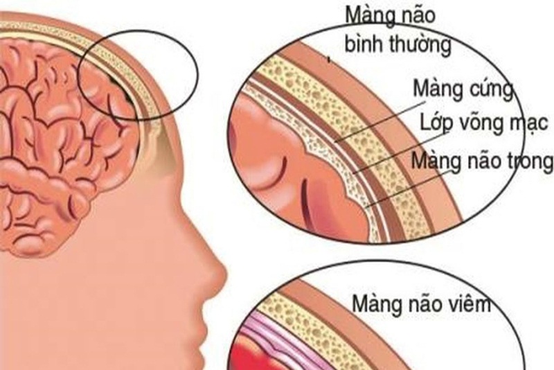 Sốt về chiều do nhiễm khuẩn màng não