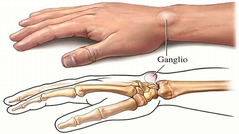 3. Triệu Chứng Của Ung Thư Xương Giai Đoạn Đầu