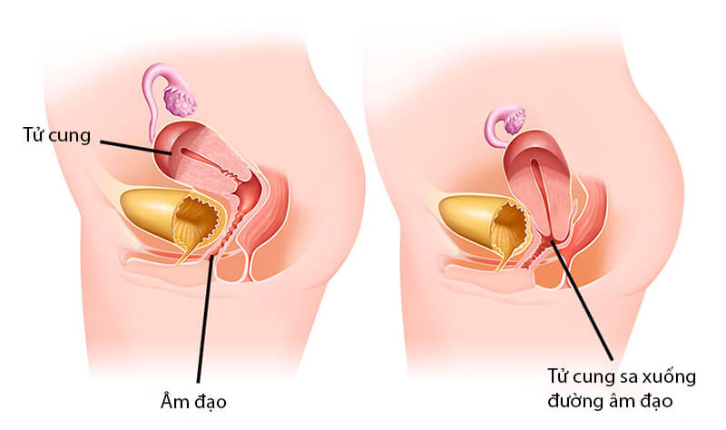 4. Các mức độ của sa tử cung