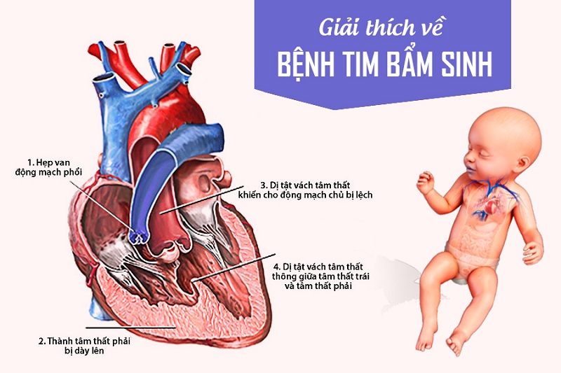 Biểu hiện lâm sàng của dị thường Ebstein rất khác nhau