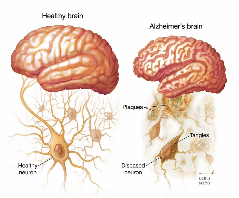 Nguyên nhân gây bệnh Alzheimer