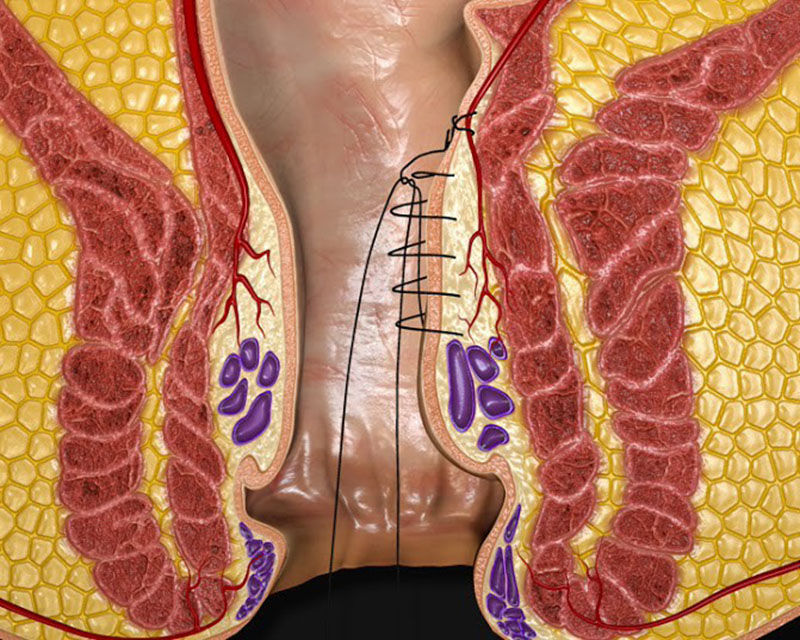Cắt trĩ bằng phương pháp Doppler ít bị đau và thời gian bình phục ngắn hơn so với các biện pháp khác