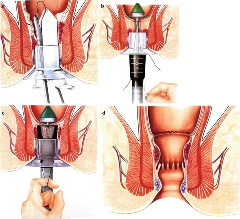 Longo một trong những phương pháp cắt trĩ hiện đại hiện nay