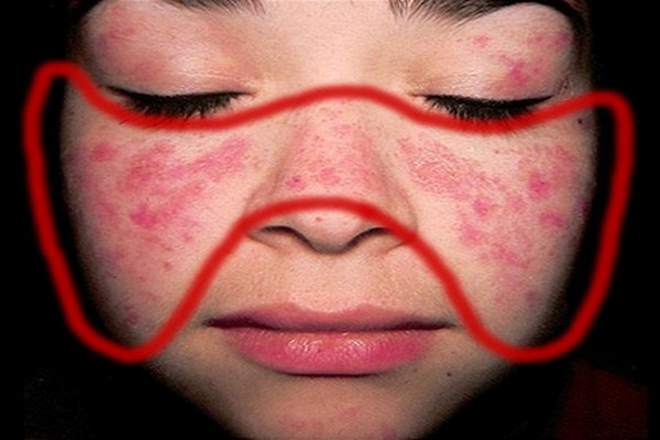 Điều Trị Bệnh Lupus Ban Đỏ