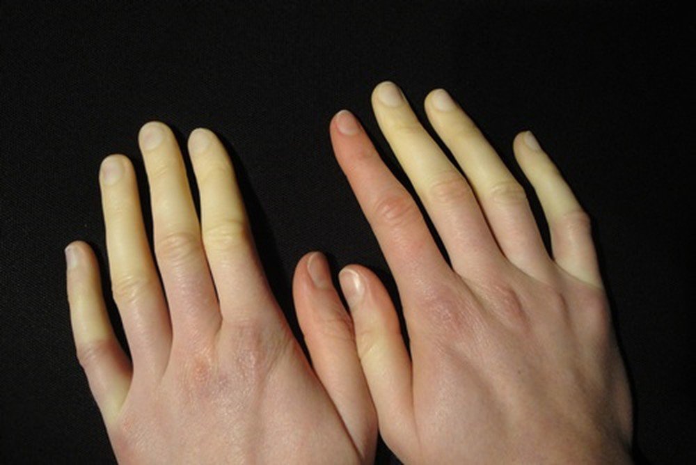 3. Thực Phẩm Cần Tránh Khi Bị Raynaud