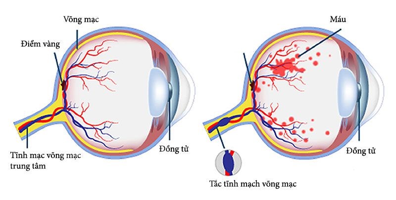 Tắc tĩnh mạch võng mạc 