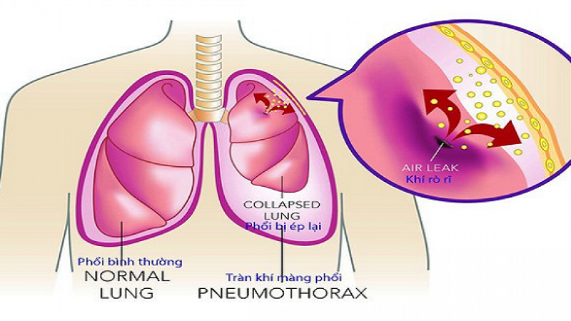 Chẩn đoán tràn dịch màng phổi