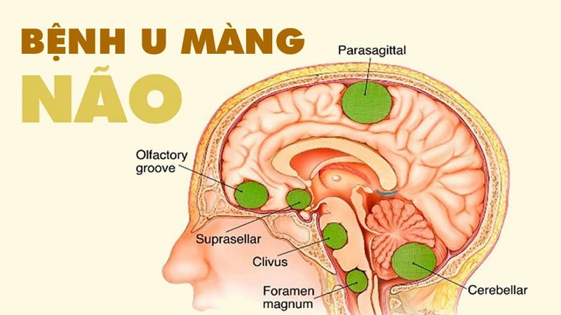 Khối u Màng Não: Những Điều Bạn Cần Biết và Cập Nhật Mới Nhất