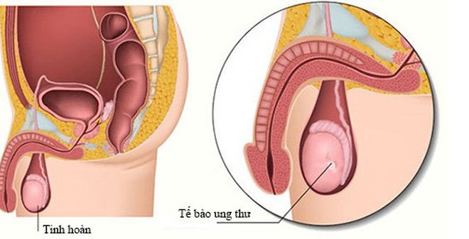 Ung thư tinh hoàn là căn bệnh ung thư hiếm gặp ở nam giới