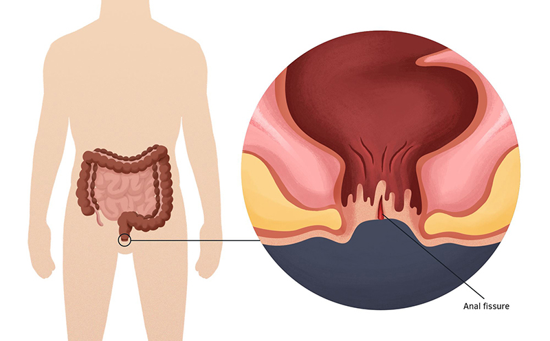 Rò hậu môn gây ảnh hưởng đến đời sống lẫn tinh thần của người bệnh