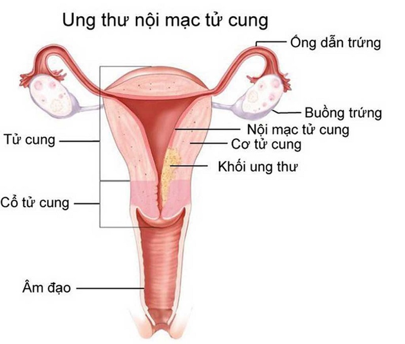 Ung thư nội mạc tử cung bắt nguồn từ các tế bào hình thành niêm mạc tử cung