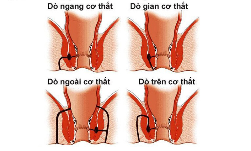 Dựa vào vị trí của các ổ rò, có thể chia rò hậu môn thành các loại chính như trên