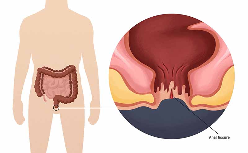 Rò hậu môn là một dạng bệnh lý xuất hiện ở vùng hậu môn - trực tràng