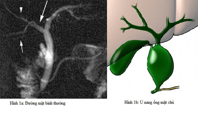 Nang ống mật chủ (BDC) là dị tật bẩm sinh hiếm gặp của đường mật