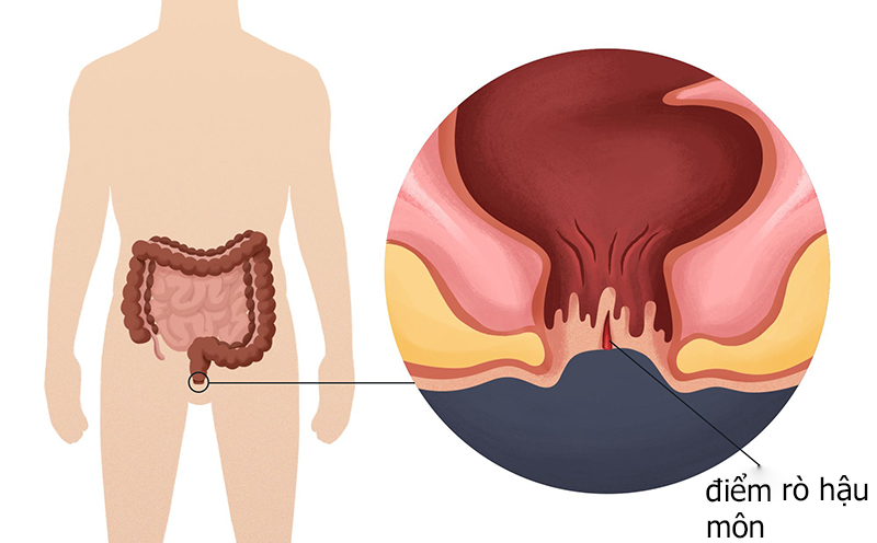 Rò hậu môn - bệnh lý mang tính chất nhiễm khuẩn mạn tính