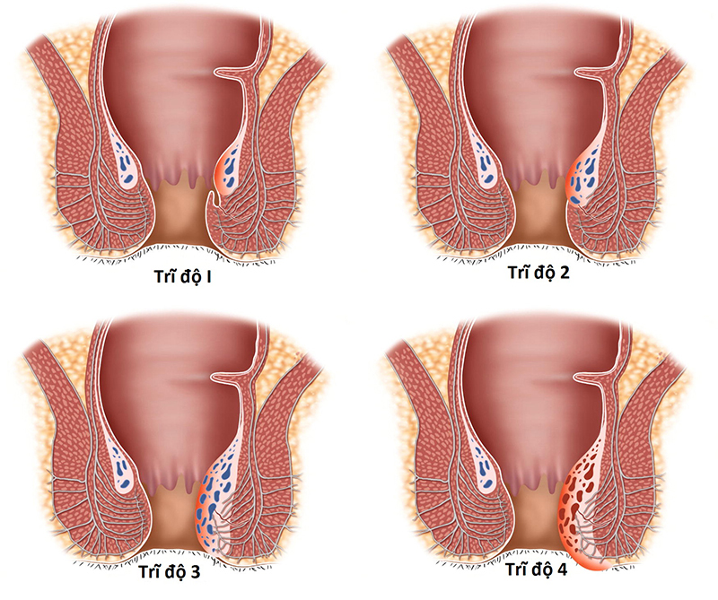 Quá trình phát triển của bệnh trĩ được chia làm 4 cấp độ