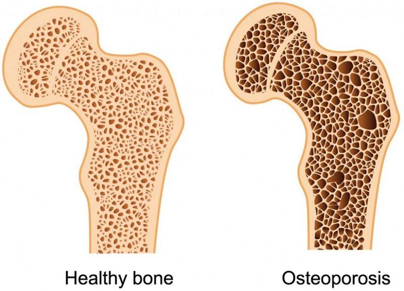 Vỡ lún cột sống thường gặp ở người bị loãng xương