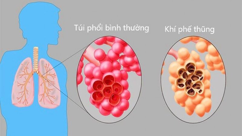 Khí phế thũng là gì