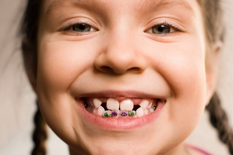 Trước khi niềng răng nên biết: Sự khác nhau giữa niềng răng trẻ em và người  lớn | Medlatec