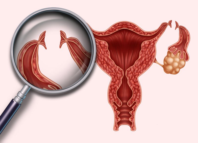 Nữ giới nên biết: thắt ống dẫn trứng để triệt sản nữ có đau không