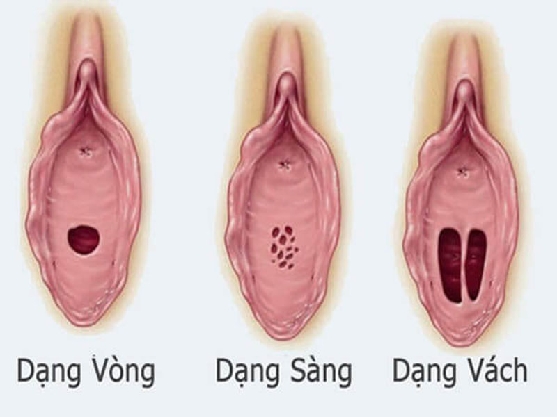 một số bất thường có thể gặp ở màng trinh