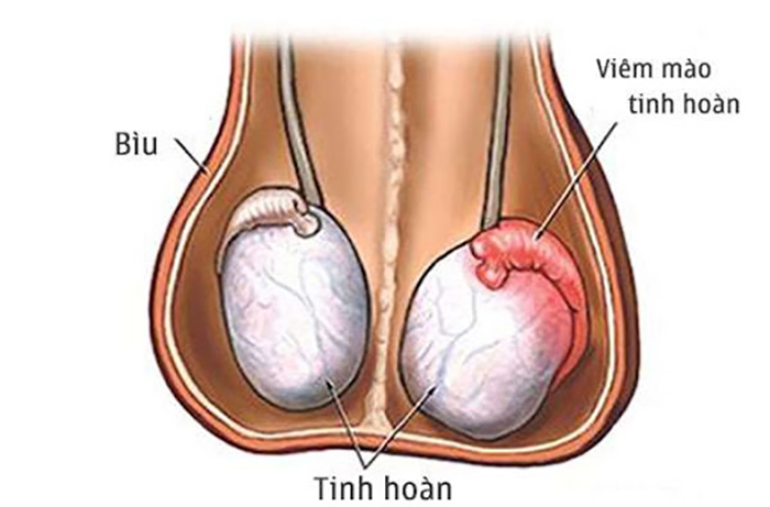 Viêm mào tinh hoàn