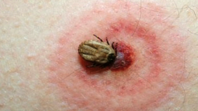 Bệnh Lyme do một loại xoắn khuẩn hình quả xoan có tên gọi khoa học là Borrelia burgdorferi lây bệnh sang người thông qua những vết đốt